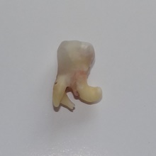 Leczenie endodontyczne Radom