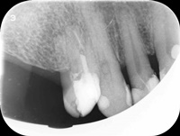 Endodoncja Radom ul. Zakręt 6