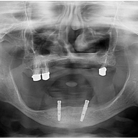 implanty stomatologiczne