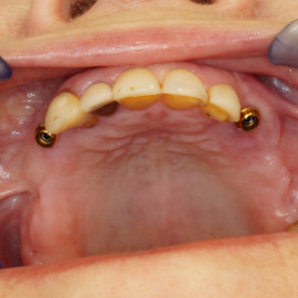 implanty stomatologiczne