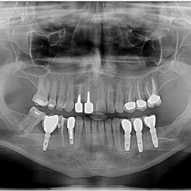 implantologia Radom