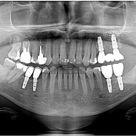 implanty stomatologiczne