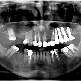 sinus lift