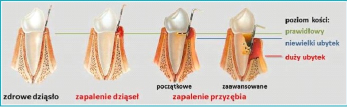 Przewlekła choroba atakująca nasze dziąsła i kości