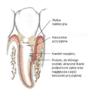 Pionowe ubytki kości wyrostka zębodołowego wokół zębów