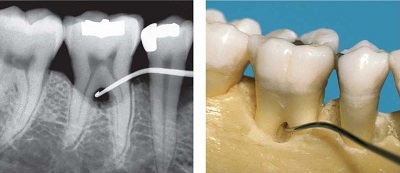 Ubytki kości w przestrzeniach międzykorzeniowych zębów trzonowych i przedtrzonowych