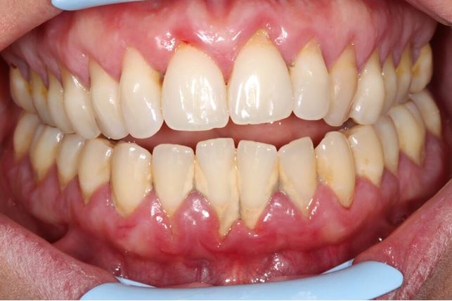Paradontoza a ortodoncja