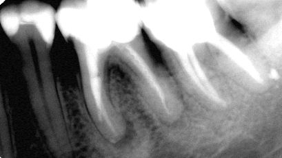 Endodoncja Radom