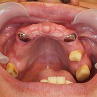 Proteza nakładowa over-denture